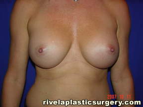 Breast Augmentation (Saline Implants)