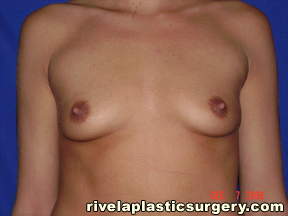 Breast Augmentation (Saline Implants)