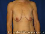 Breast Augmentation with Lift