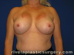 Breast Augmentation with Lift