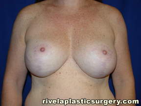 Breast Augmentation with Lift