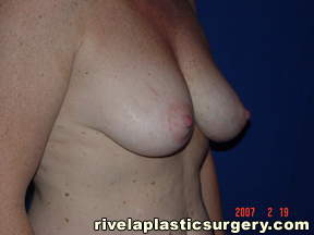 Breast Augmentation with Lift