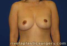 Breast Reduction Surgery