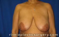 Breast Reduction Surgery