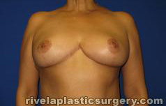 Breast Reduction Surgery