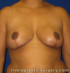 Breast Reduction Surgery