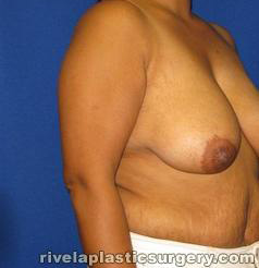 Breast Reduction Surgery