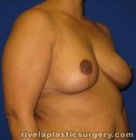 Breast Reduction Surgery