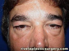 Lower Eyelid Surgery (Blepharoplasty)