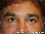 Lower Eyelid Surgery (Blepharoplasty)