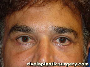 Cirugía de Párpados Inferiores (Blefaroplastia)