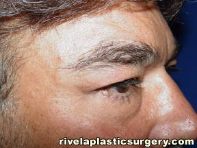 Lower Eyelid Surgery (Blepharoplasty)