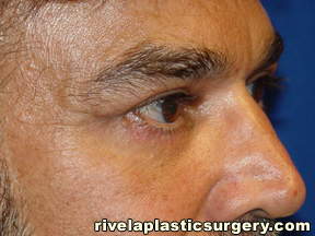 Cirugía de Párpados Inferiores (Blefaroplastia)