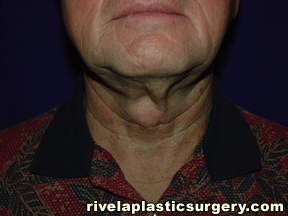 Neck Lift