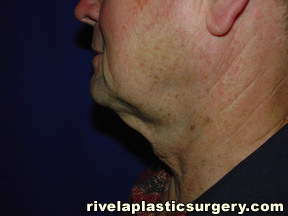 neck with saggy skin, Neck Liposuction, Houston TX Montgomery Conty MD