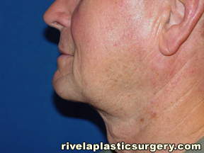 neck after Neck Liposuction, Houston TX Montgomery Conty MD