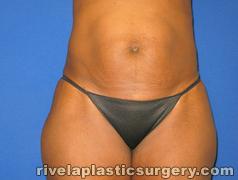 Tummy Tuck (Abdominoplasty)