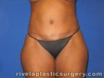 Tummy Tuck (Abdominoplasty)