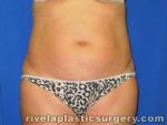 Tummy Tuck (Abdominoplasty)