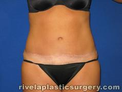 Tummy Tuck (Abdominoplasty)