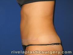 Tummy Tuck (Abdominoplasty)