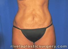 Tummy Tuck (Abdominoplasty)