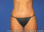 Tummy Tuck (Abdominoplasty)