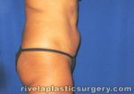 Tummy Tuck (Abdominoplasty)