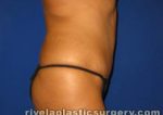 Tummy Tuck (Abdominoplasty)