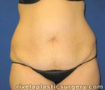 Tummy Tuck (Abdominoplasty)