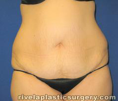 Tummy Tuck (Abdominoplasty)