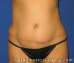 Tummy Tuck (Abdominoplasty)