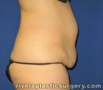 Tummy Tuck (Abdominoplasty)