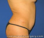 Tummy Tuck (Abdominoplasty)