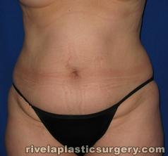 Tummy Tuck (Abdominoplasty)