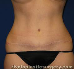 Tummy Tuck (Abdominoplasty)