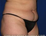 Tummy Tuck (Abdominoplasty)