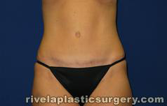 Tummy Tuck (Abdominoplasty)