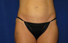 Tummy Tuck (Abdominoplasty)