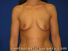Breast Symmetry