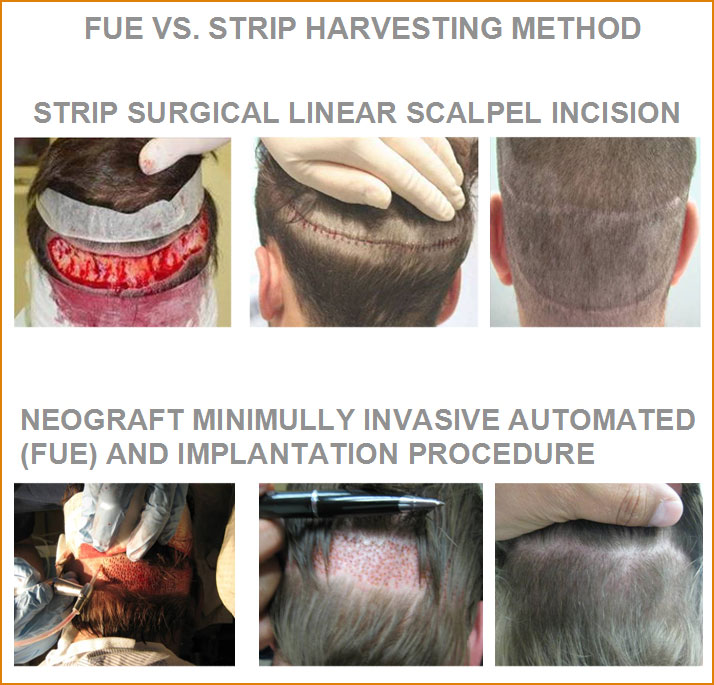 Fue and Strip Harvesting Method - Neograft Hair Restoration at The Woodlands