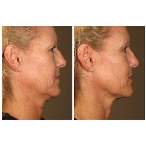 Rivela Plastic Surgery is now pleased to offer the latest in Ultherapy® in The Woodlands TX.