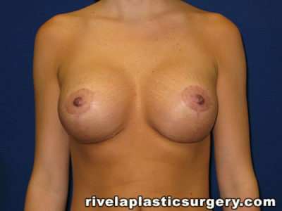 Breast Augmentation with Lift