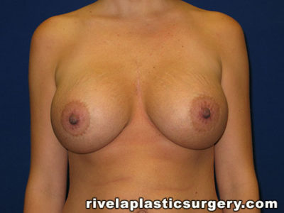 Breast Augmentation with Lift