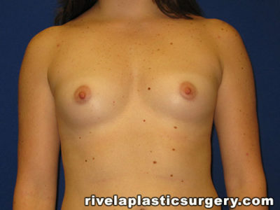 Breast Augmentation (Silicone Gel Implants)