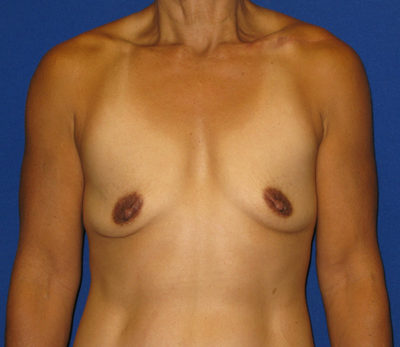 Breast Augmentation (Breast Implants)