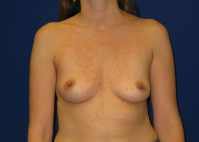 Breast Augmentation (Breast Implants)