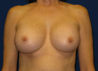 Breast Augmentation (Breast Implants)