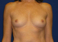 Breast Augmentation (Breast Implants)