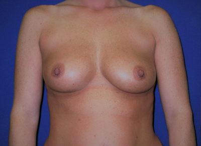 Breast Augmentation (Breast Implants)
